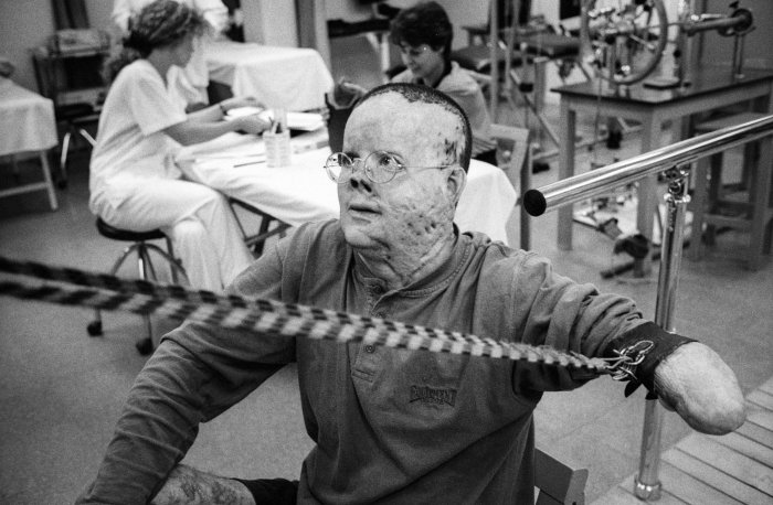 Recovering  Xavier in a Major Burn Unit